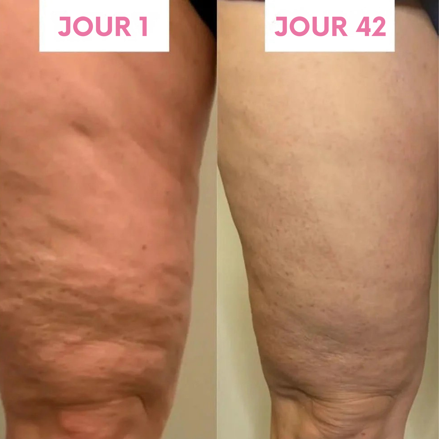 Masseur électrique à ventouses - Bella Cellulite Drainer