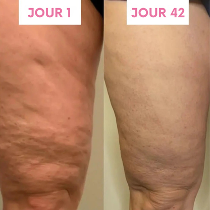 Masseur électrique à ventouses - Bella Cellulite Drainer